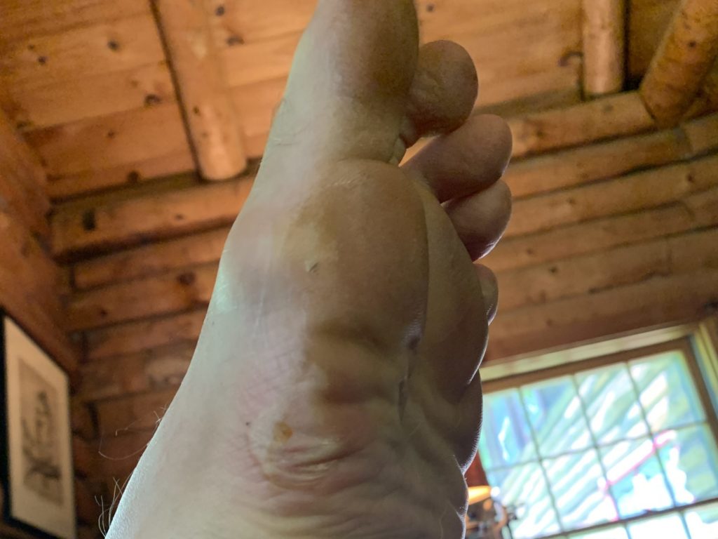 A photo of my foot with a large blister on my foot, taken 2 days after finishing.